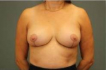 BREAST REDUCTION: Case 30 After